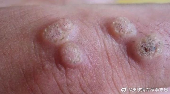 疣事论斯一气，探寻背后的奥秘与重要性，疣事论斯一气，背后的奥秘与重要性探究